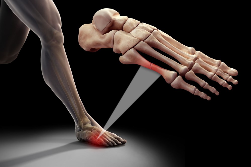 Foot pain in dance